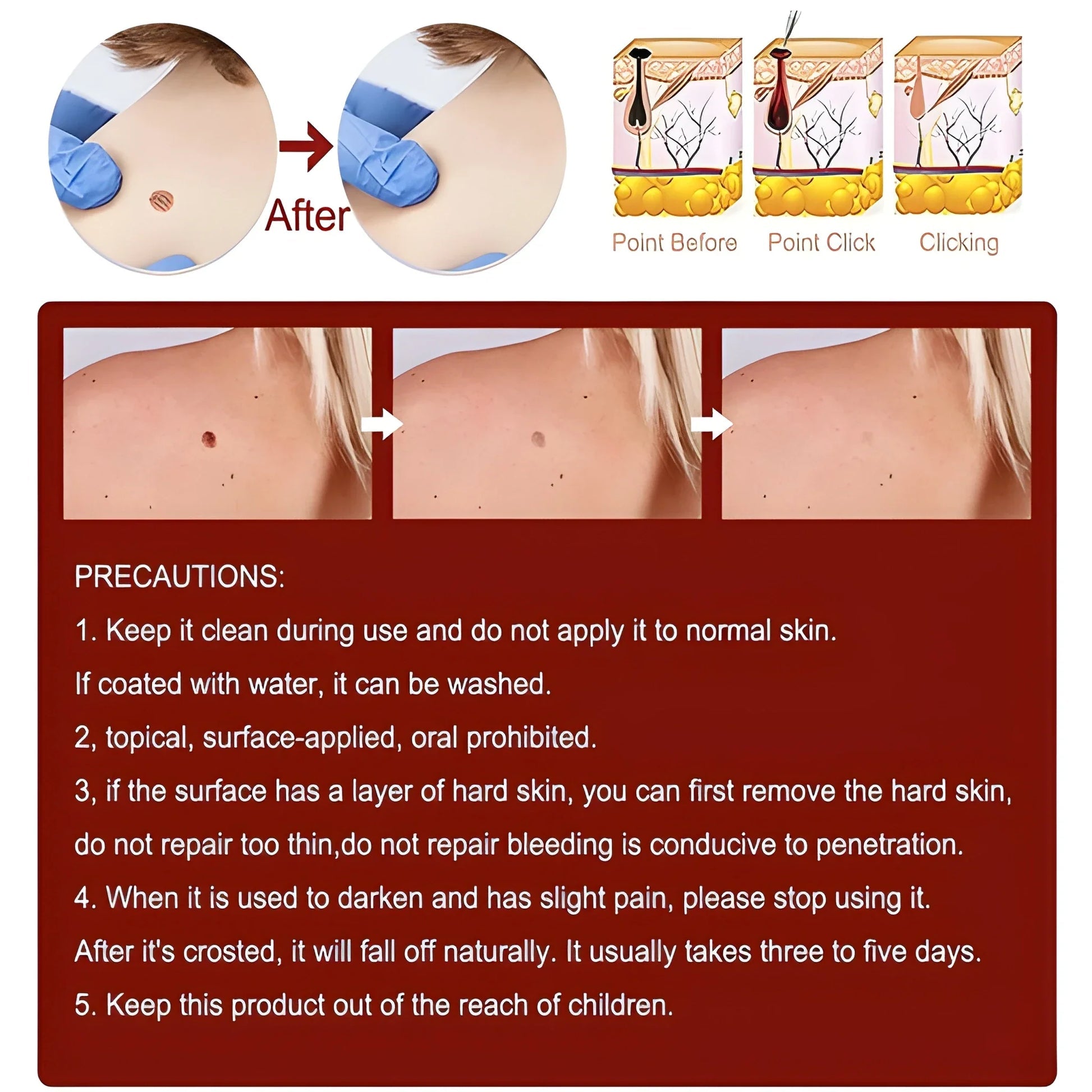DermaClear™ Tags &amp; Moles Remover (🔥 Buy 1 Get 1 Free 🔥)