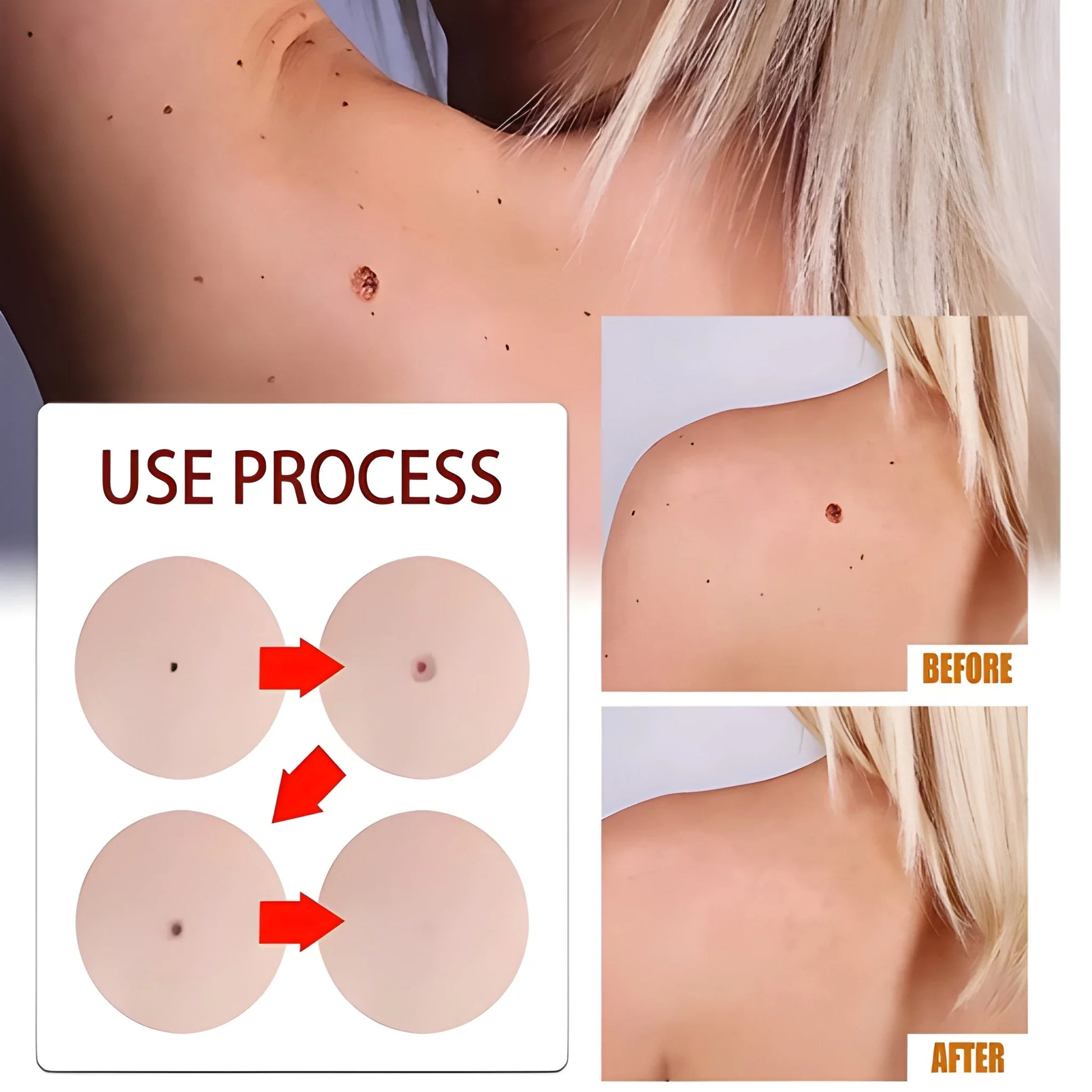 DermaClear™ Tags &amp; Moles Remover (🔥 Buy 1 Get 1 Free 🔥)