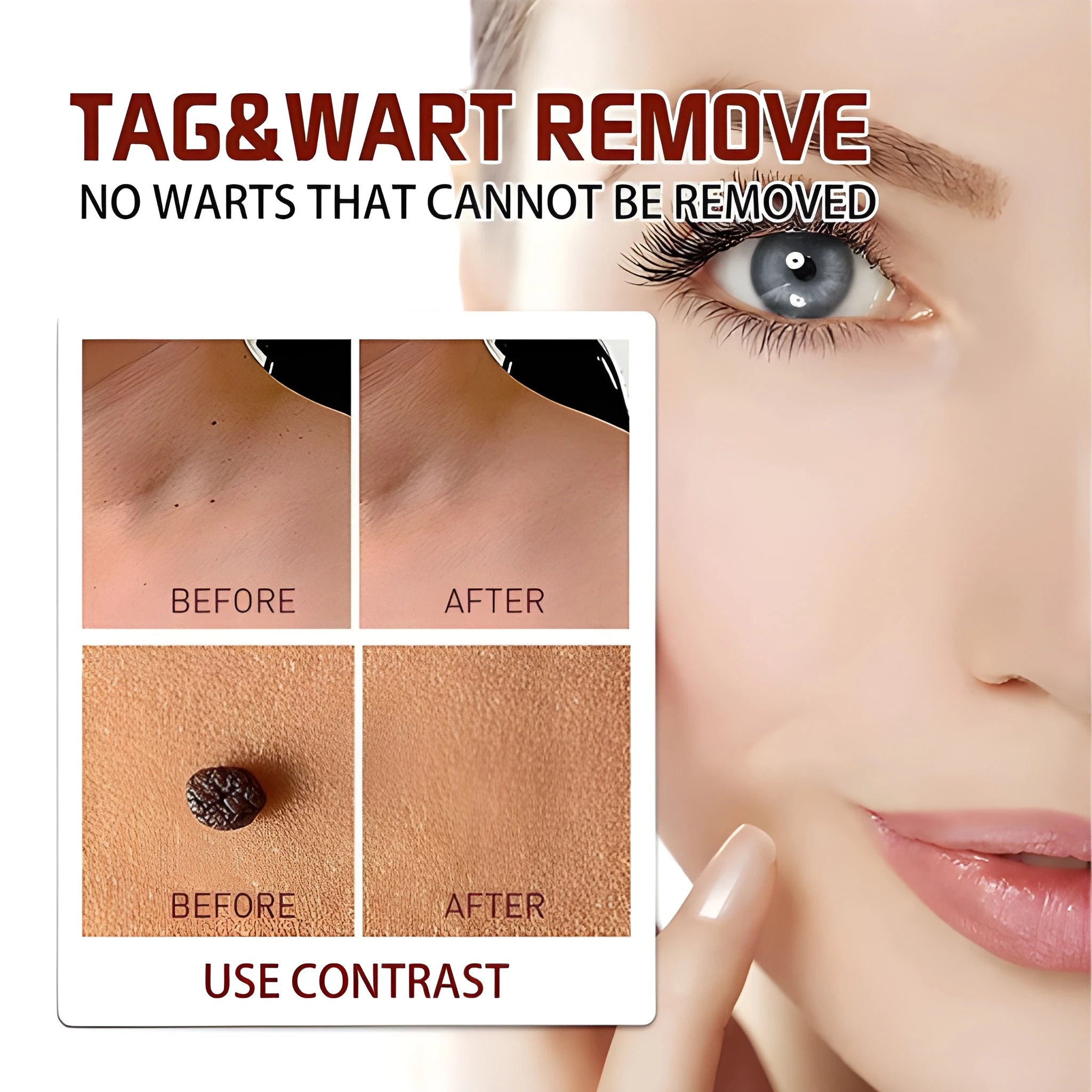 DermaClear™ Tags &amp; Moles Remover (🔥 Buy 1 Get 1 Free 🔥)